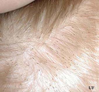 Head lice in hair